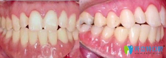 深圳佳美口腔半口牙種植術(shù)后效果圖