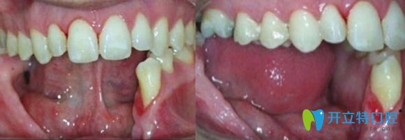 半口種植牙術(shù)前照
