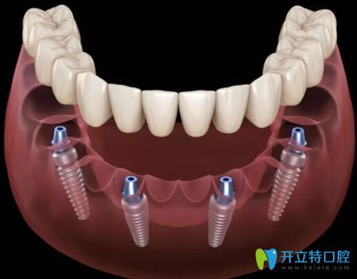 寧波恒美口腔allon4全口種植技術