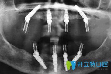 我在寧波恒美口腔做種植牙后的CT片