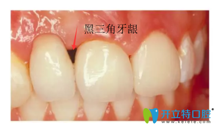 2牙齦黑三角怎么回事