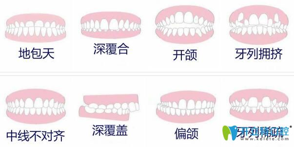 牙齒矯正適應人群