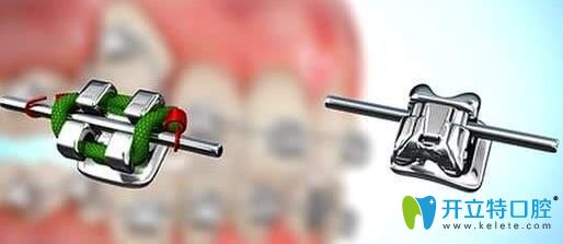 自鎖托槽和普通托槽對比圖