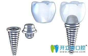 德國ankylos種植系統(tǒng)特點(diǎn)