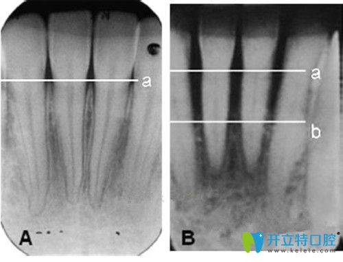 牙槽骨不足可以種牙嗎?解析牙槽骨條件差到底能不能種牙?