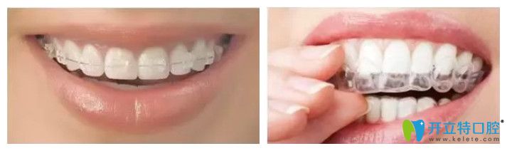 中山好民生口腔半隱形矯正和全隱形矯正價格