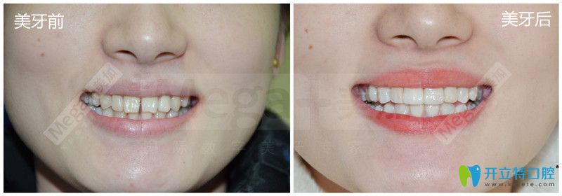 牙黃做美加牙貼面美容效果