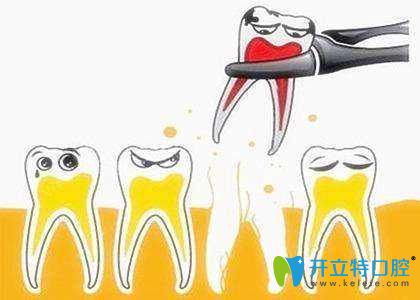 牙齒松動(dòng)要拔牙嗎