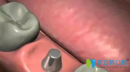 愈合基臺(tái)更換修復(fù)基臺(tái)