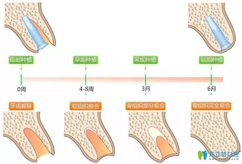 即刻種植牙和傳統(tǒng)種植牙區(qū)別
