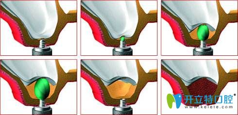上頜竇內(nèi)提升術(shù)