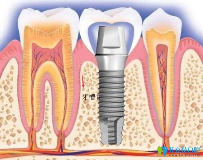 種植體距離上頜竇距離多少安全？穿透上頜竇有什么問(wèn)題？