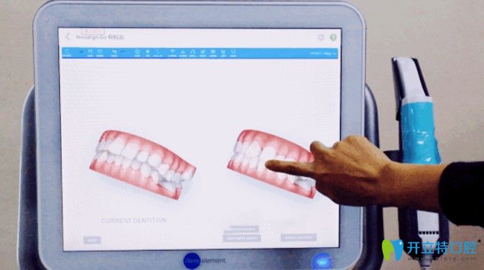 維樂口腔iTero口掃可以讓你提前預(yù)知矯正效果