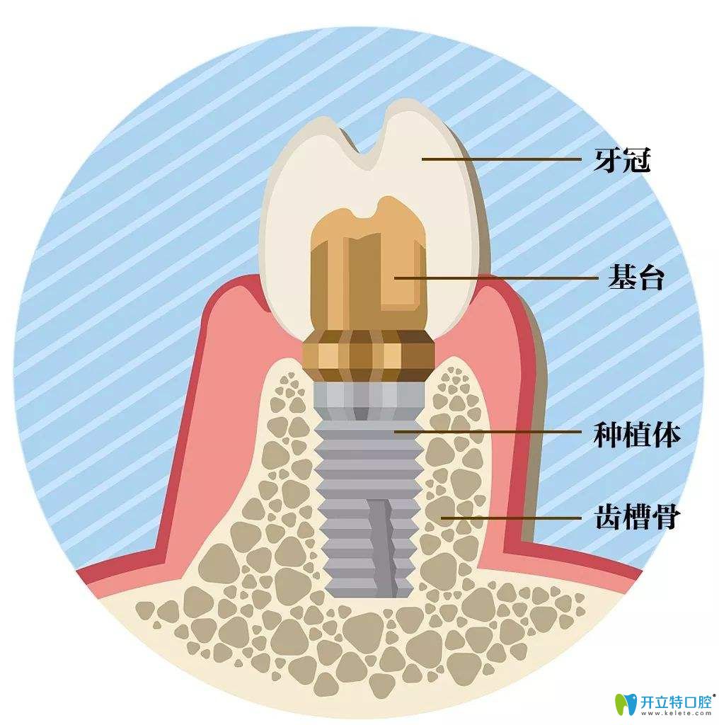 種植牙示意圖