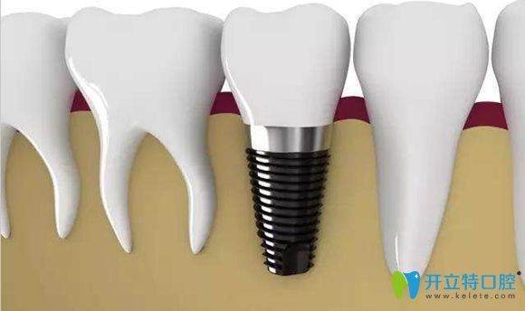 僑諾口腔有多種種植牙品牌可供選擇