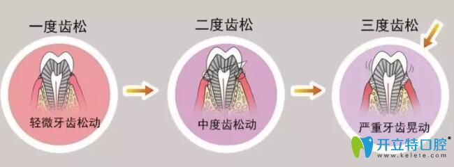 牙齒松動(dòng)的程度