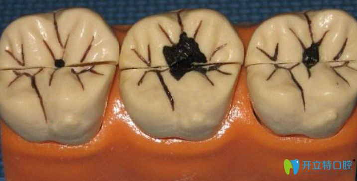 邵榮文解析牙齒上有小黑點(diǎn)是怎么回事