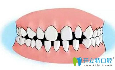 以親身經(jīng)歷告知大家牙間隙過(guò)大有哪些危害以及治療方法