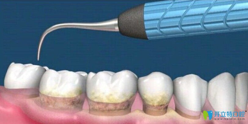 邵榮文解析牙齒上有小黑點(diǎn)該怎么辦