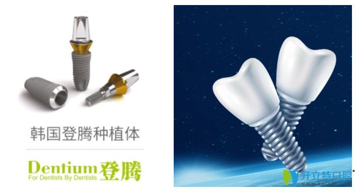 福州維樂口腔登騰種植牙價(jià)格