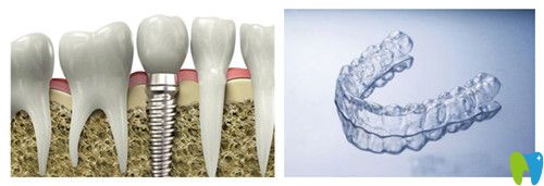 種植牙的種植體該怎么選擇
