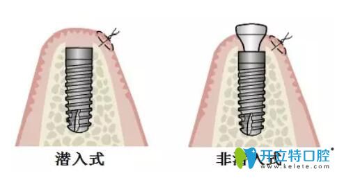 埋入式種植與非埋入式種植的區(qū)別