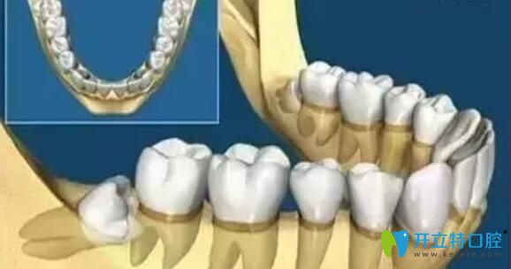 阻生牙拔除多少錢？先看看阻生智齒拔除難度有多大