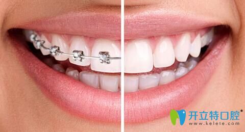 牙齒矯正效果圖