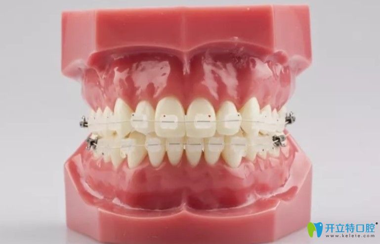 看完半隱形牙齒矯正價(jià)格表你就知道陶瓷托槽矯正多少錢啦