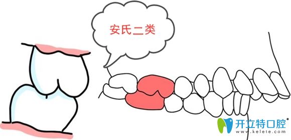 安氏二類癥狀示意圖