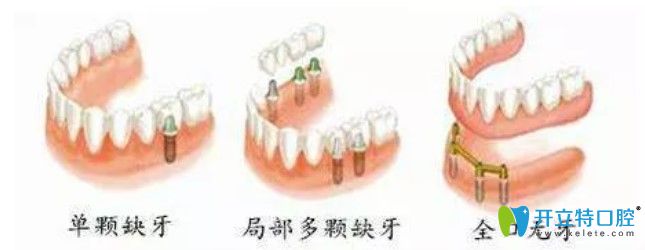 種植牙可選即刻種植牙技術(shù)