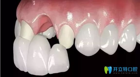 只有一兩顆烤瓷牙，還是可以考慮進(jìn)行牙齒矯正的
