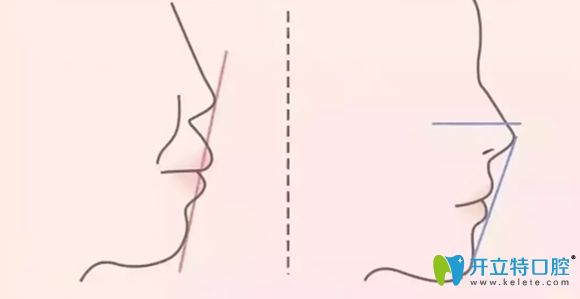 牙齒牙頜前突矯正前后對(duì)比圖