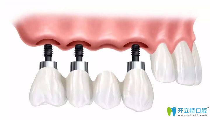 種植牙過程