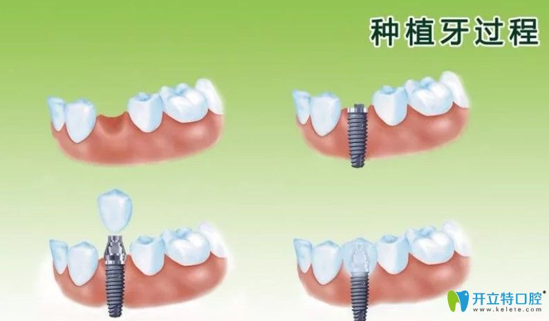 種植牙過(guò)程圖示