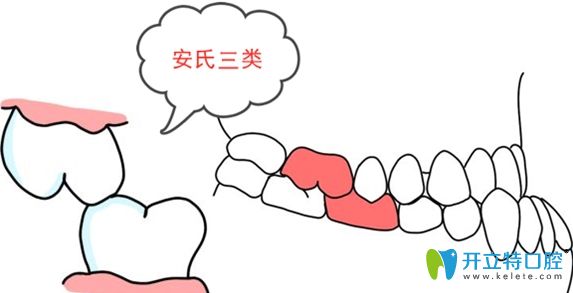 安氏三類錯(cuò)頜癥狀示意圖