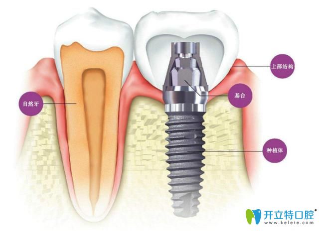 天津愛齒口腔周貴祥醫(yī)生分享即刻種植牙手術(shù)過程