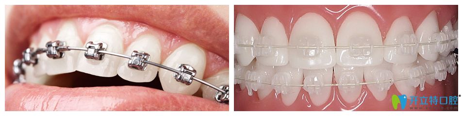 傳統(tǒng)矯正方式與英式快速矯正方式