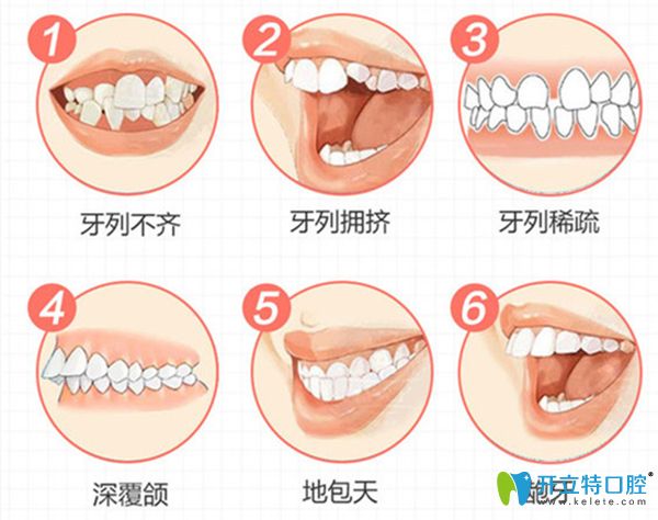 自鎖托槽矯正適用人群
