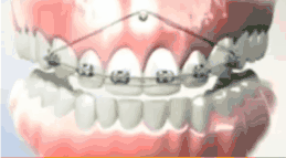 支抗釘?shù)蜕锨把? border=