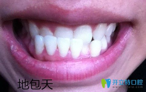 牙頜畸形之地包天圖片