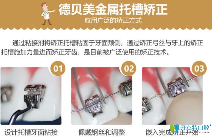 德貝美口腔牙齒矯正特色技術(shù)之金屬托槽矯正