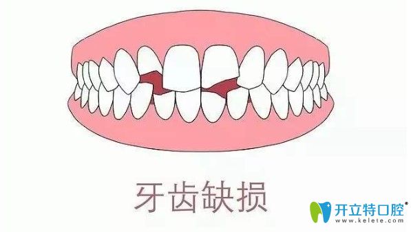 段煉醫(yī)生科普牙齒缺損的修復方式有哪些