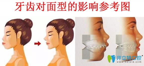 牙齒不齊對面型的影響圖