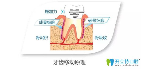 正畸加速器的牙齒移動原理