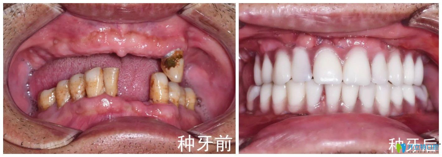 長沙中諾口腔立得用全口中種植牙對比圖