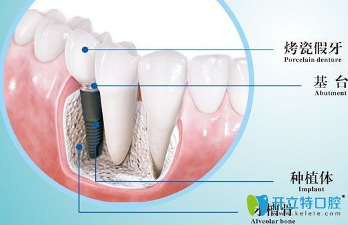 種植牙結構分布