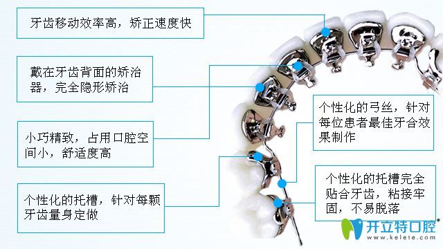 舌側(cè)牙齒矯正的優(yōu)缺點(diǎn)