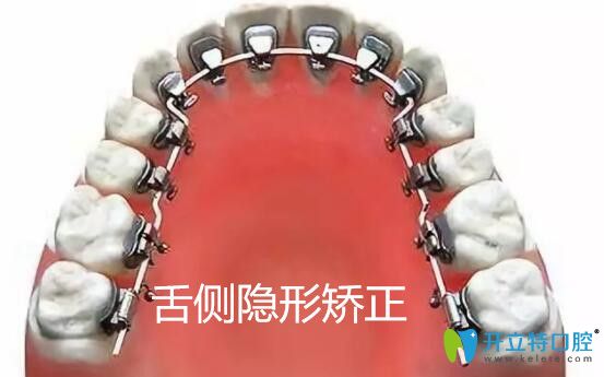 做舌側(cè)牙齒矯正會(huì)大舌頭嗎?從舌側(cè)隱形矯正的優(yōu)缺點(diǎn)來了解