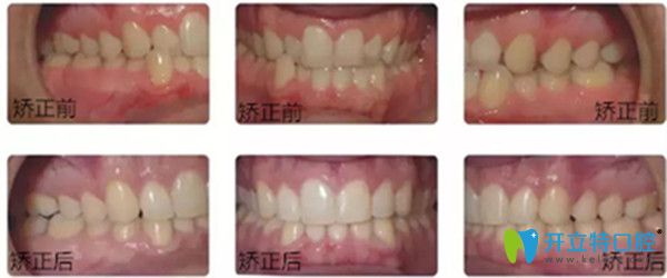 美速達正畸加速器效果前后對比